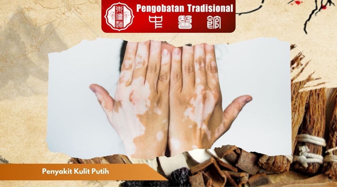 Penyakit Kulit Putih: Penyebab hingga Perawatan yang Tepat