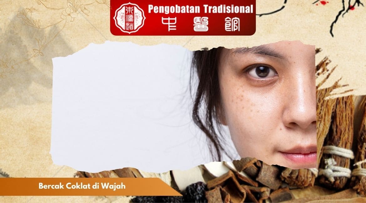 Penyebab Bercak Coklat di Wajah dan Cara Menghilangkannya