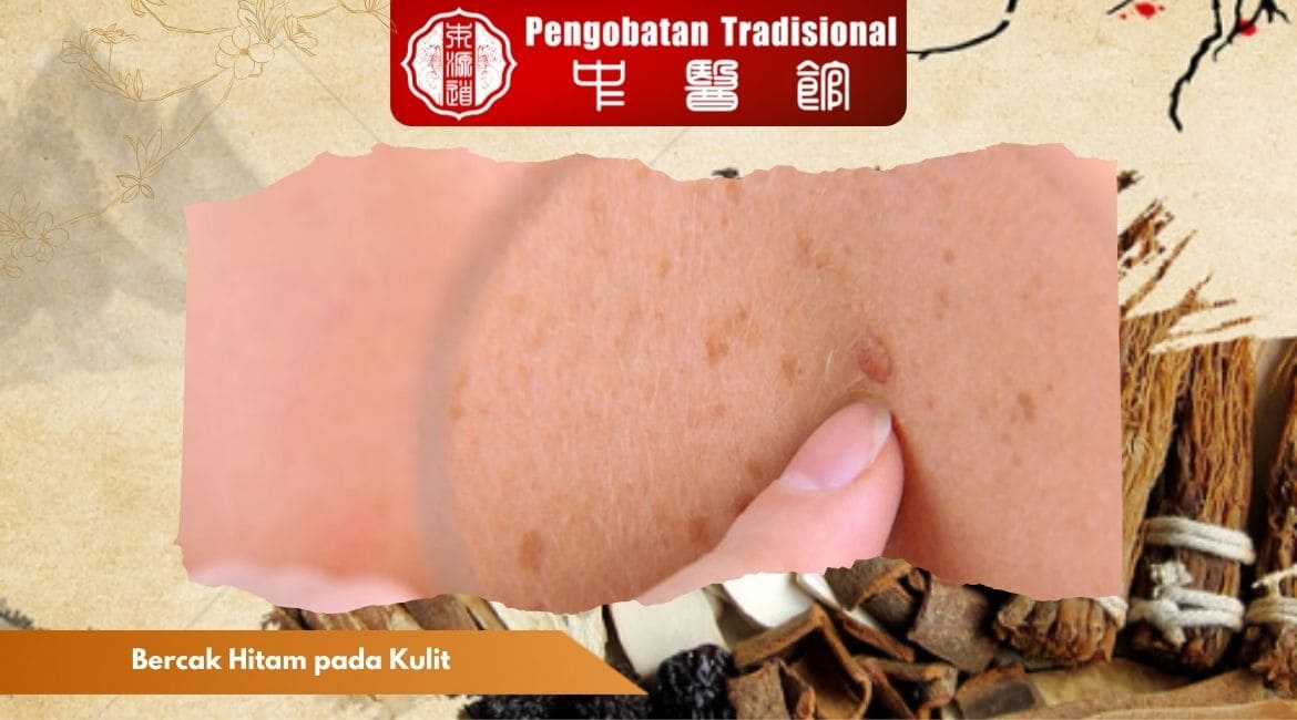 Bercak Hitam pada Kulit: Penyebab, Jenis, Cara Mengatasinya