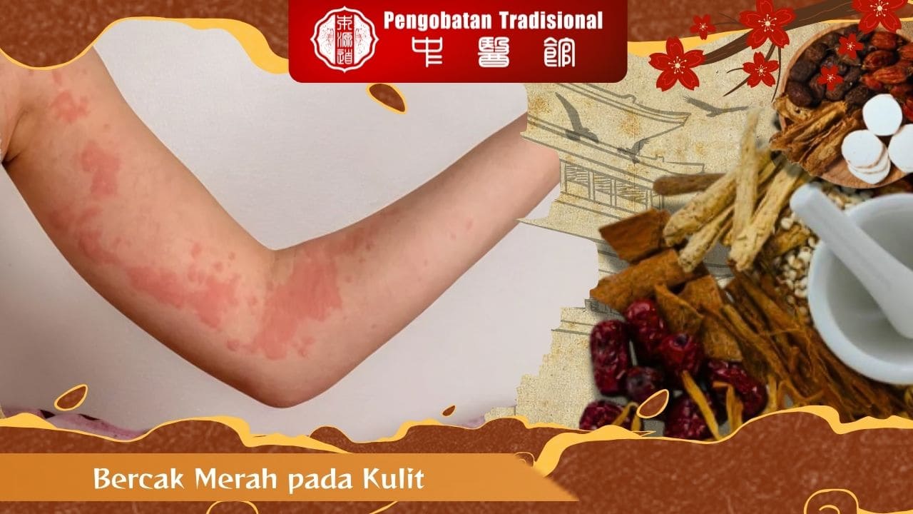 Bercak Merah pada Kulit Bisa Menandakan Masalah Kesehatan